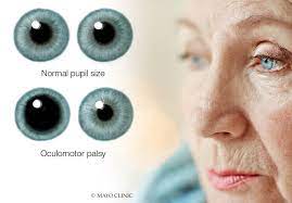 Neuro-Ophthalmic Presentations of Ocular Cranial Nerve Palsies