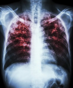 Treatment and Management of Latent Tuberculosis Infection in Lethargic Patient