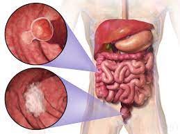 Rectal and colon cancer: Not just a different anatomic site